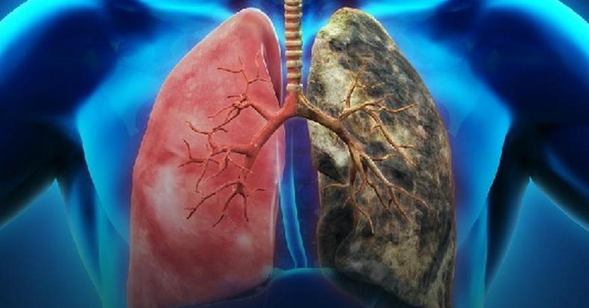 wczesne objawy raka płuc