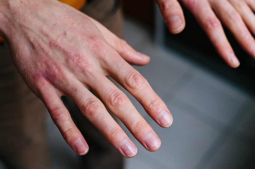 choroby które widać na dłoniach